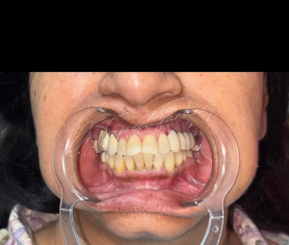 Frontal retracted intraoral photograph showing upper fixed restorations and lower natural teeth